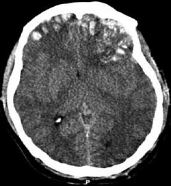 Kompüter tomoqrafiyası müayinəsi: beyin kontuziyası, beyindaxili qansızma, subdural hematoma və kəllə sümüyünün sınığı
