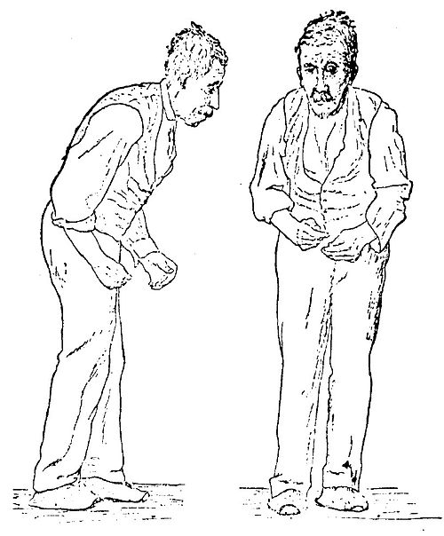 Parkinson xəstəliyi