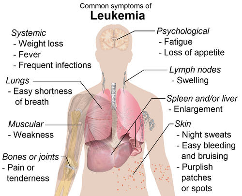 Leykemiya (xəstəlik)